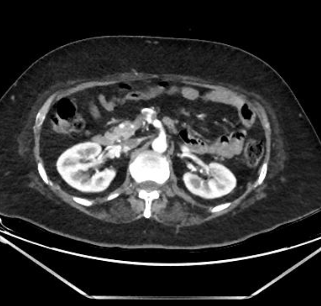 CTA image demonstrating inferior pancreaticoduodenal artery aneurysm and coeliac origin stenosis