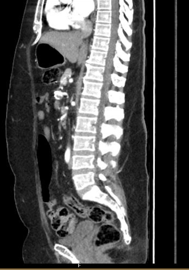 CTA reconstruction showing inferior pancreaticoduodenal artery aneurysm with coeliac origin stenosis
