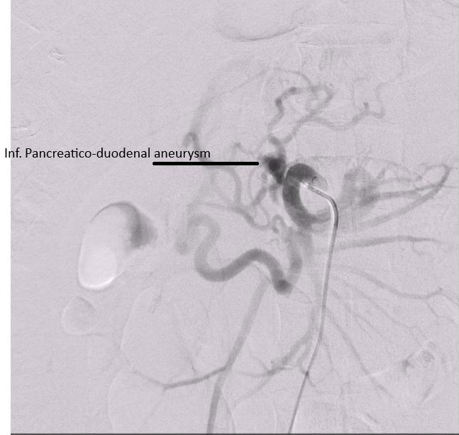 Pre-coiling DSA showing inferior pancreaticoduodenal artery aneurysm