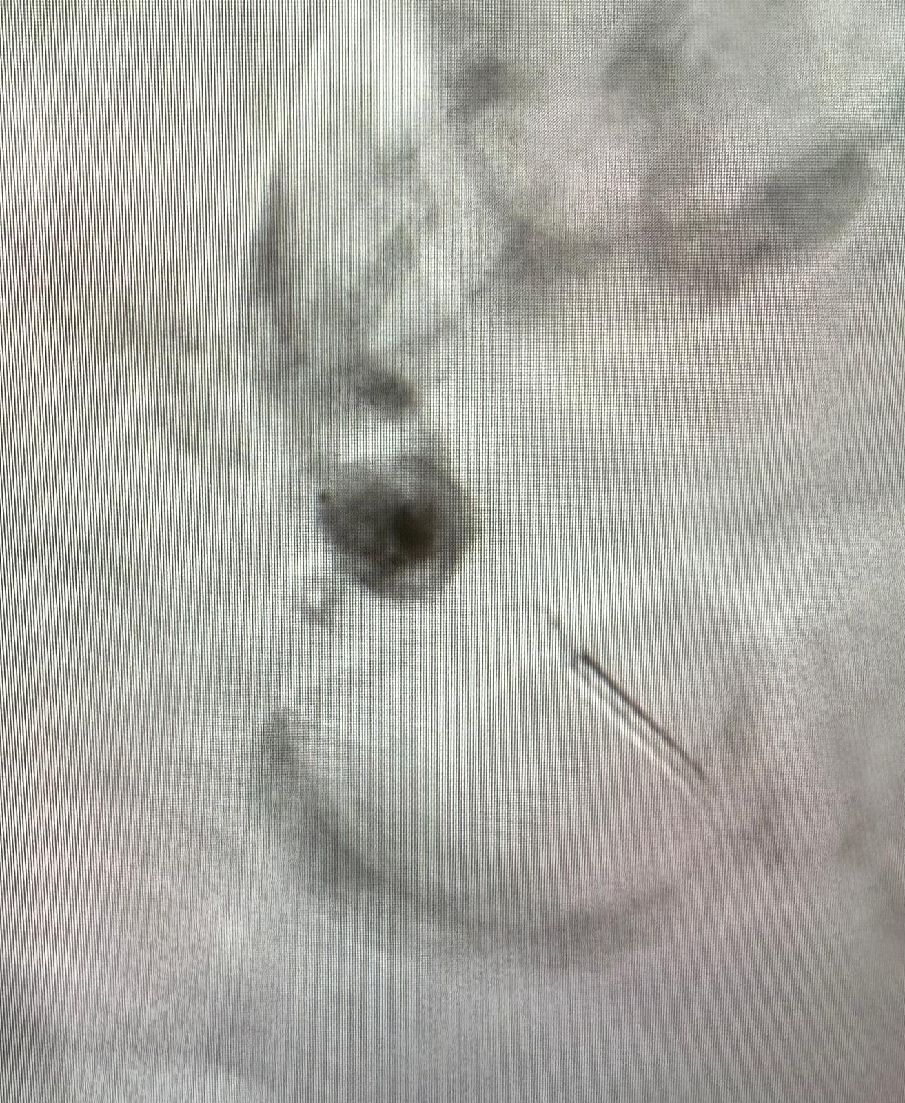 Second pre-coiling DSA view of the inferior pancreaticoduodenal artery aneurysm