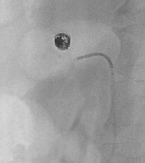 Post-embolisation angiogram confirming coil pack position and aneurysm exclusion